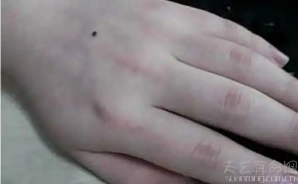 手背痣相图解手背有善痣预示会理财
