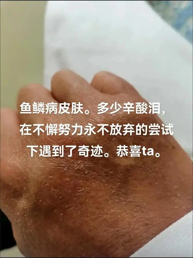 鱼鳞病皮肤多少辛酸泪在不懈努力永不放弃中见到了奇迹恭喜ta