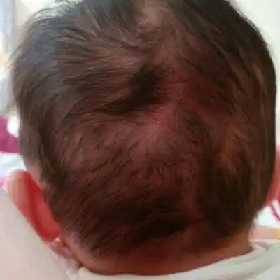 小孩儿后脑勺一片红 咋回事