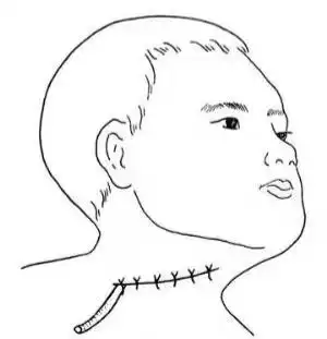 甲状腺癌术后出现"乳糜漏",千万要"管住嘴"