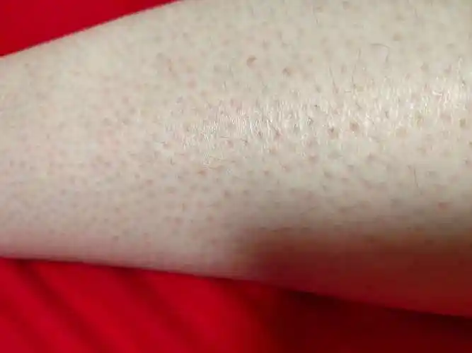 密集恐惧症,像是每个毛孔都是红红的,非常难看,请问这是毛囊炎吗?