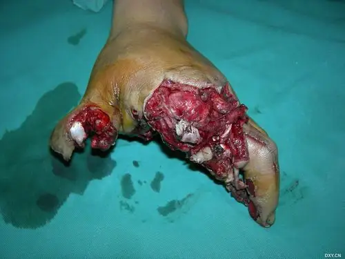游离足趾移植修复拇指 - 骨科专业讨论版 -丁香园论坛