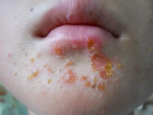 典型脓疱疮一例