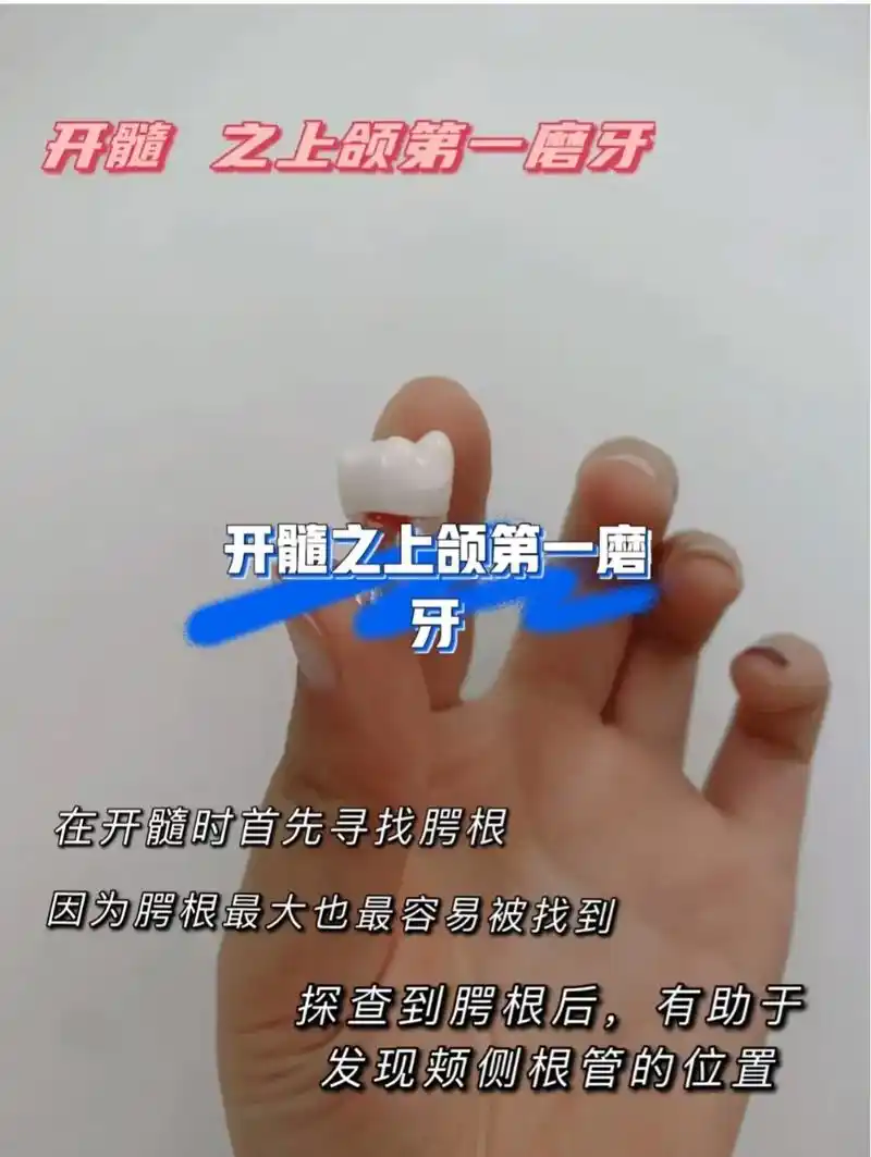 开髓之上颌第一磨牙.#口腔科普 - 抖音