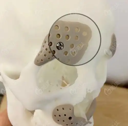 peek材料修复下颌角用钛钉固定比较稳固