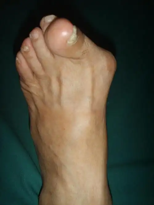 大脚骨整形专家 的想法: 有的拇外翻脚趾会钻入第二趾的下方, br>但是