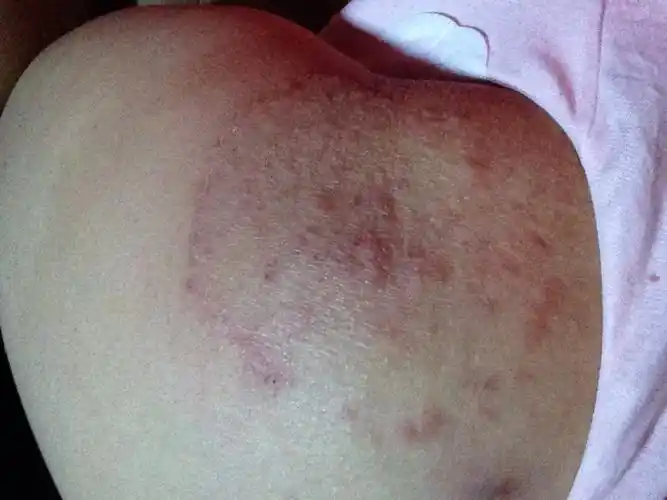 屁股上长包特别痒有图片的特别是姨妈期它就长起来了