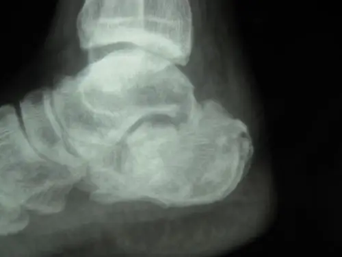 跟骨骨折畸形愈合一例求助治疗方案