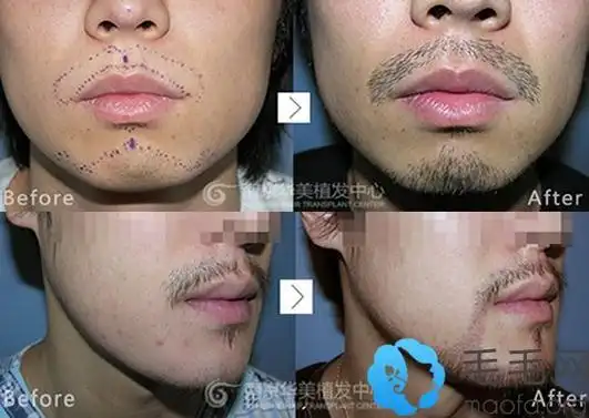 南京华美刘学新主任胡须种植效果对比图