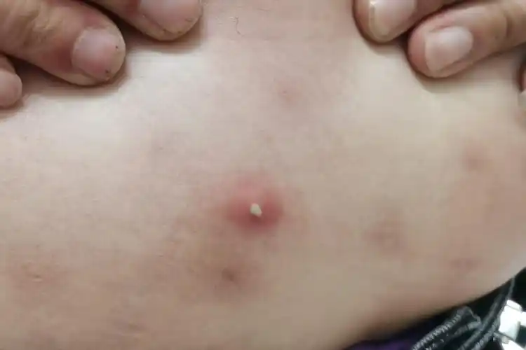 白塞氏假性毛囊炎图片