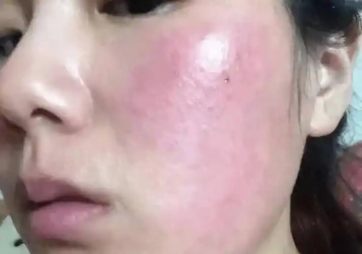 试试这个方法,7天轻松去除红血丝!_进行_皮肤_地方