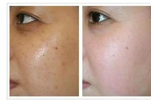 脸上暗沉无光泽特别蜡黄怎么办 皮肤偏黄怎么改善