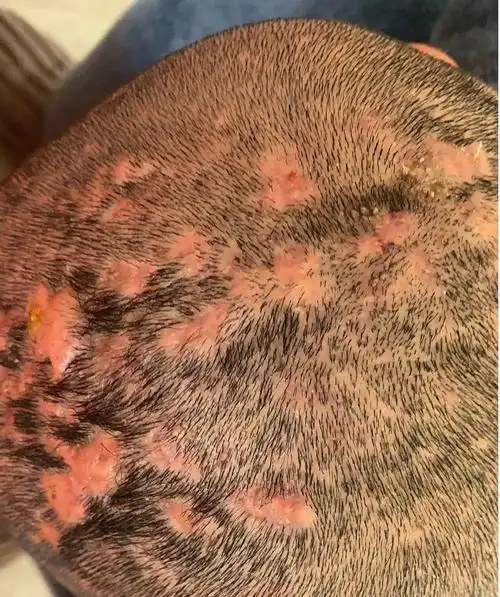 调皮有道李志忠 的想法: 【每日一方】分享一个治疗穿掘性毛囊炎的