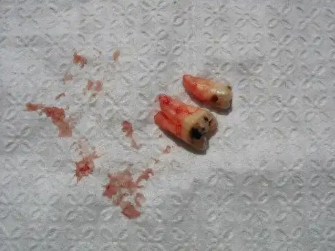 长了智齿到底需不需要拔掉?不拔会怎么样?