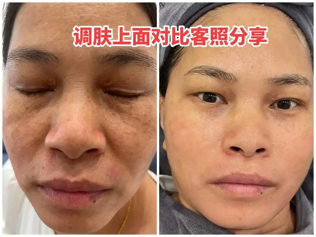 调肤前后对比客照分享.粗黑黄,斑敏痘#问题性皮肤管理 #皮肤 - 抖音