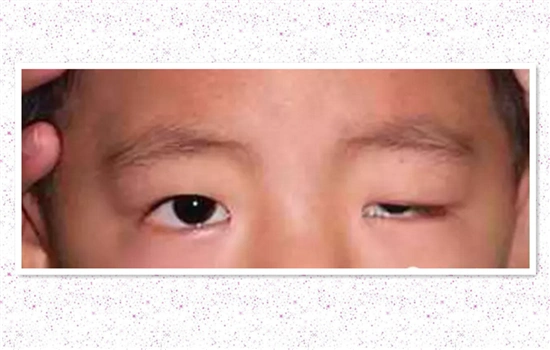 眼睑下垂手术适宜年龄一直不做眼睑矫正会怎样