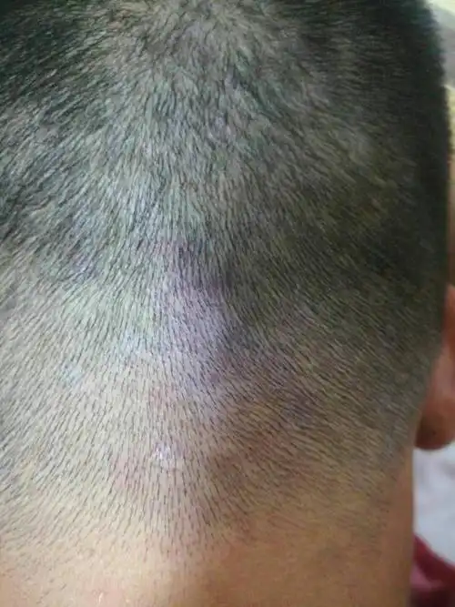 前几天去剪头发…师傅发现头皮有红斑块…不知道是什么情况.不痛不痒.