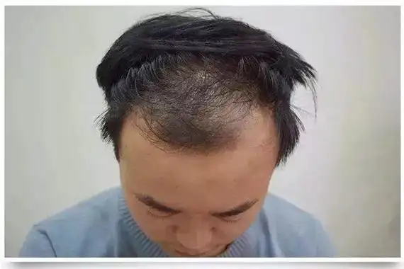 发际线后移擦生姜行吗