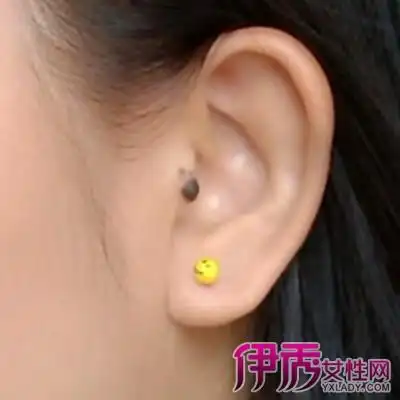 详解耳朵有痣的含义