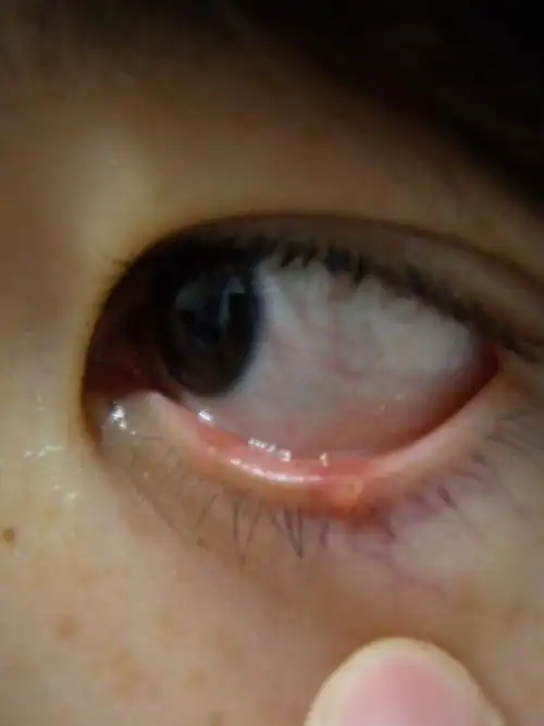 下眼睑上长了一个东西 快1个多月了