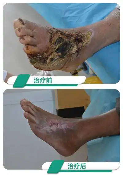 糖尿病足一定会截肢吗?