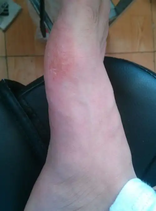 昨天由于太痒 抹了点达克宁 今早起来就这样了 有严重脚气