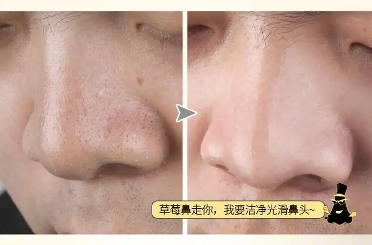 去黑头神器终结套装清洁毛孔粗大修复收缩男女强力鼻贴鼻头贴强吸