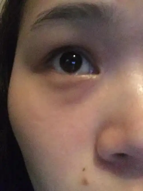 眼睛底下,眼袋处,时不时长个像蚊子咬了一样的小包,有点痒,而且越