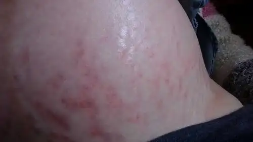 肚皮上长了很多又红又痒的疙瘩,怎么回事?