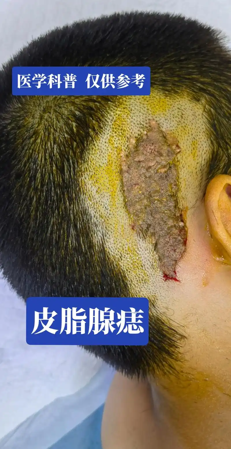 皮肤问题 #胎记 #头皮上长疙瘩是怎么回事 #黑色素痣 # - 抖音