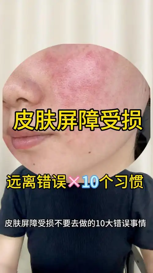 激素脸屏障受损,想要修好,远离这10个错误的习惯