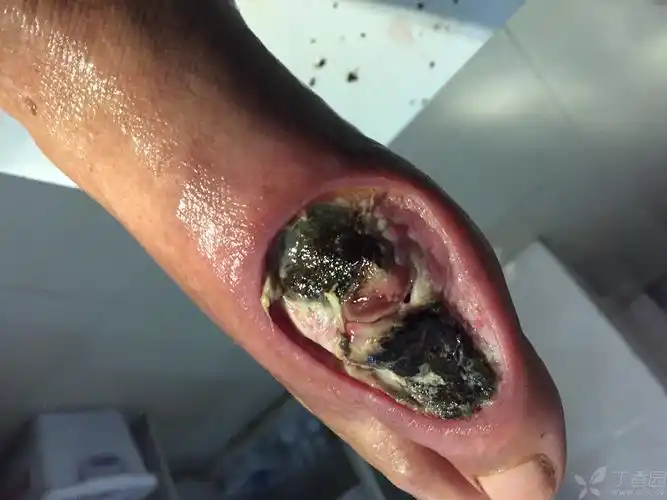 患者69岁,右足外侧皮肤缺损并坏死