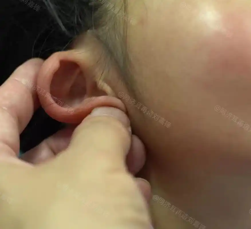 小女孩是湖北黄冈人,刚满五岁,两只耳朵缺少对耳轮,都立不起来.