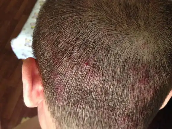 【图】头皮上长痘痘又痒怎么办 日常生活中有什么要注意的