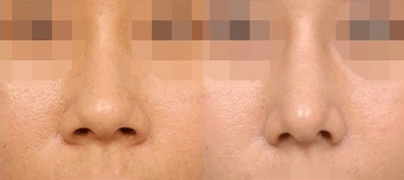 鼻头肥大怎么办