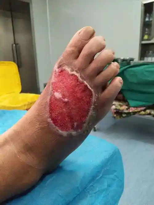 外二科救治一例创面坏死有感