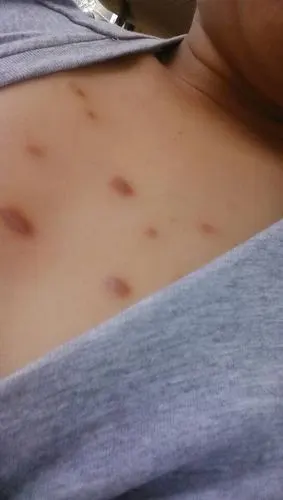 胸口豆子消了之后,长了很多黑色的疙瘩,不