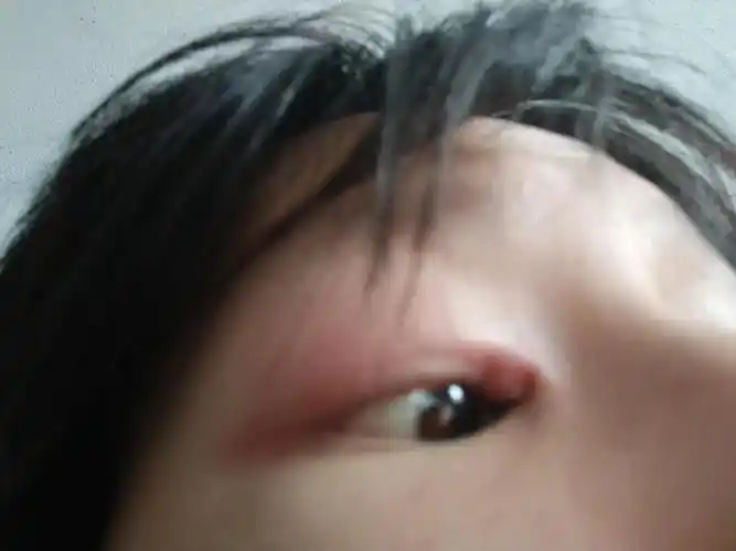 眼角长了一个包,会疼会痒,早上醒来一双眼都是眼屎