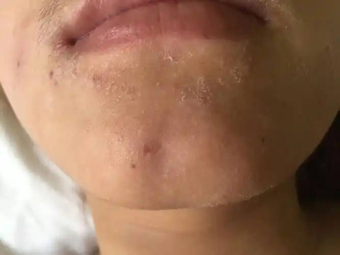 脸部干燥脱皮怎么办?