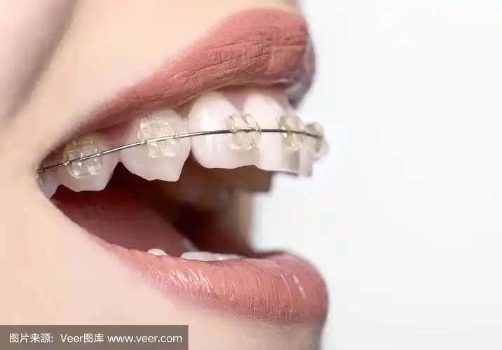 带牙套的牙齿侧面图
