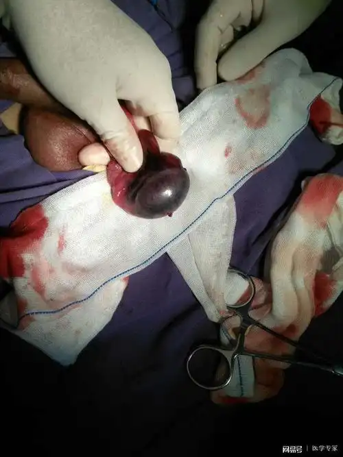 "蛋蛋"扭转了怎么办?命根子啊!很疼的!