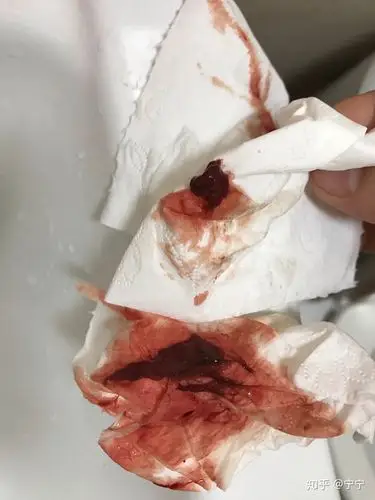 2019年7月24药物流产流血一个月没清宫已完全恢复