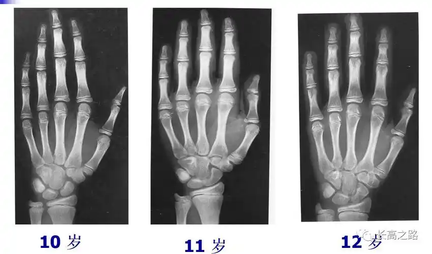 教你简单识别孩子的骨龄片