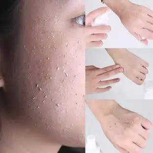 去角质素喷雾女男全身手足脸面部身体啫喱去死皮黑头鸡皮肤磨砂膏