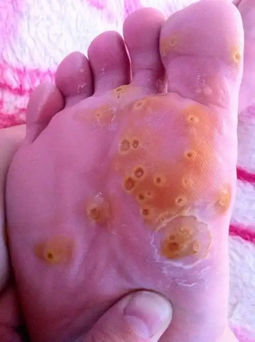 四级 1,到药店买5块钱的鸦胆子,是一种散的中药; 2,买一包酒精棉