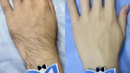 北京朝阳大悦城《铭轩男士·私密脱毛》 小帅哥脱掉手上的毛毛,手指