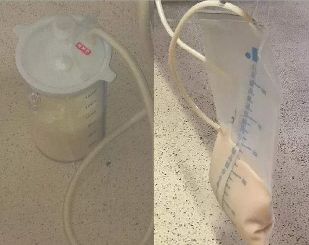 "乳糜"的前世今生