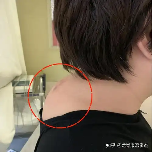 斜方肌大富贵包等不良体态是哪些原因造成如何正确消除