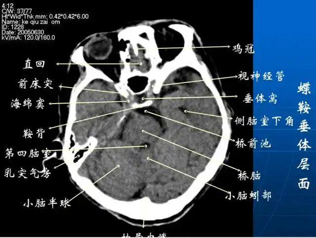 头颅ct解剖与常见出血梗死判读