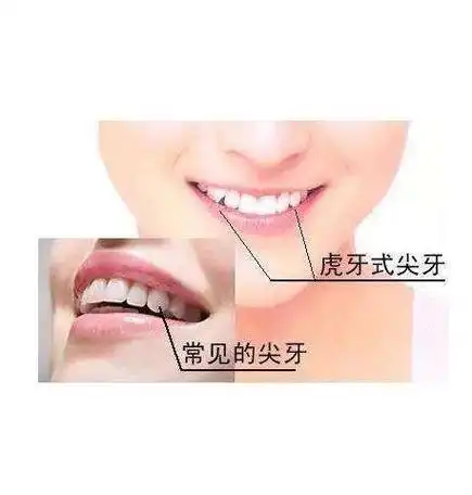 01看起来可爱的虎牙隐藏着你不知道的坏处